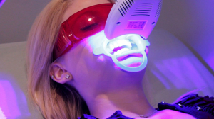 Tẩy Trắng Răng công nghệ Plasma