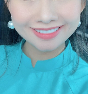 Dán Sứ Veneer