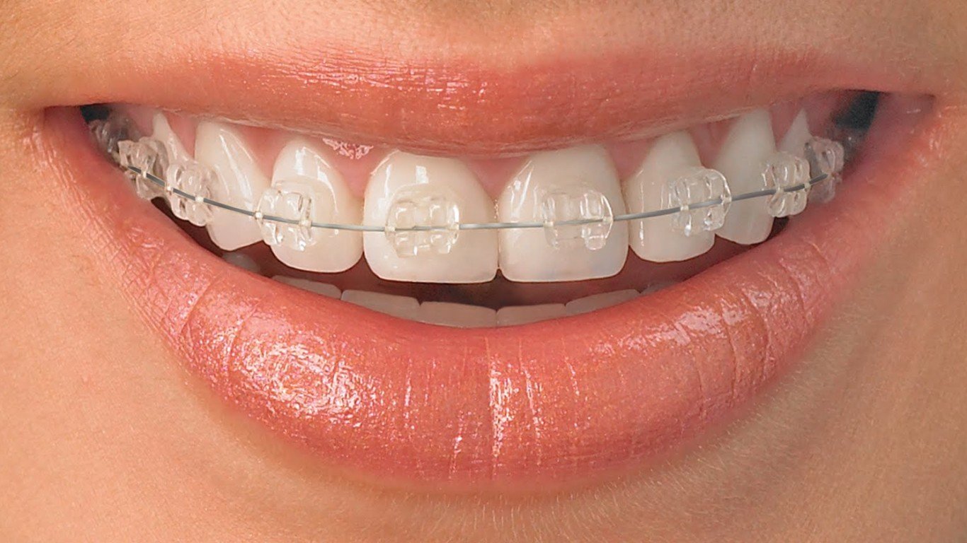 Kỹ Thuật Niềng Răng Mới Nhất Biên Hòa