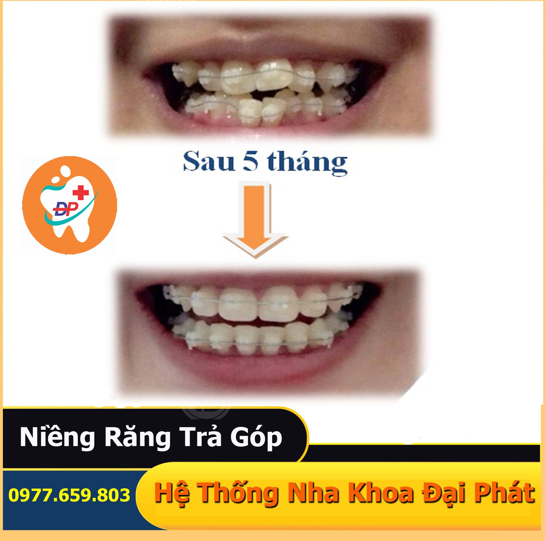 NIỀNG RĂNG TRẺ EM CẦN LƯU Ý NHỮNG GÌ ?
