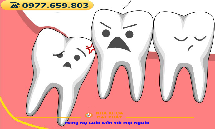 KHI NÀO THÌ NHỔ RĂNG KHÔN ??