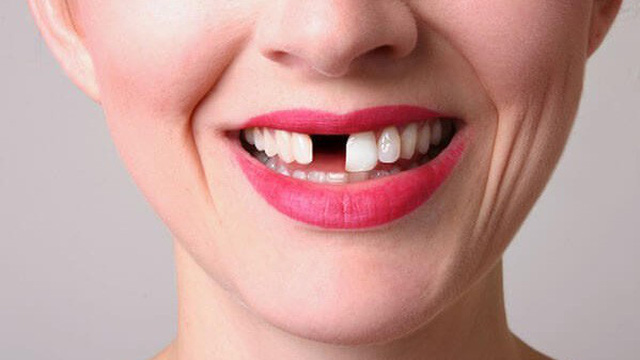 TÁC HẠI KHÔN LƯỜNG CỦA VIỆC MẤT RĂNG
