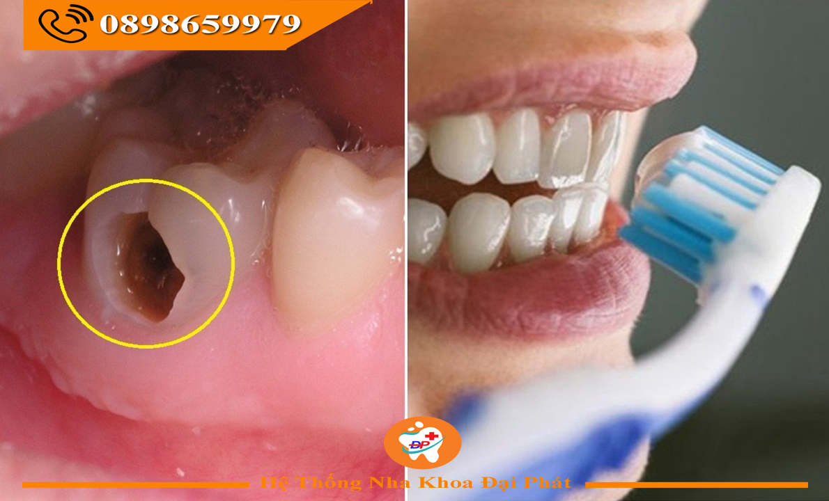 TẠI SAO ĐÁNH RĂNG KỸ MÀ VẪN SÂU RĂNG