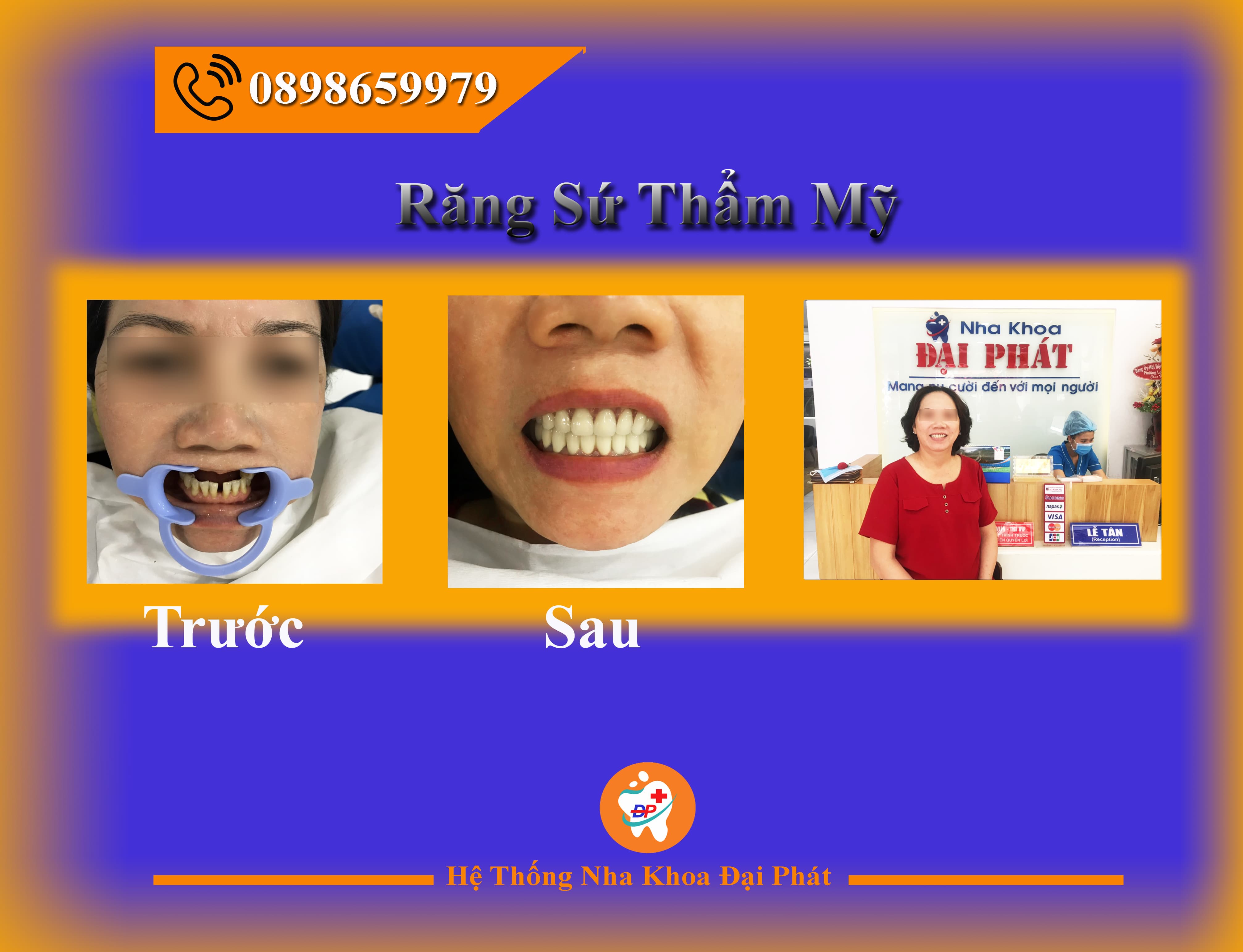 LỢI ÍCH CỦA VIỆC BỌC RĂNG SỨ