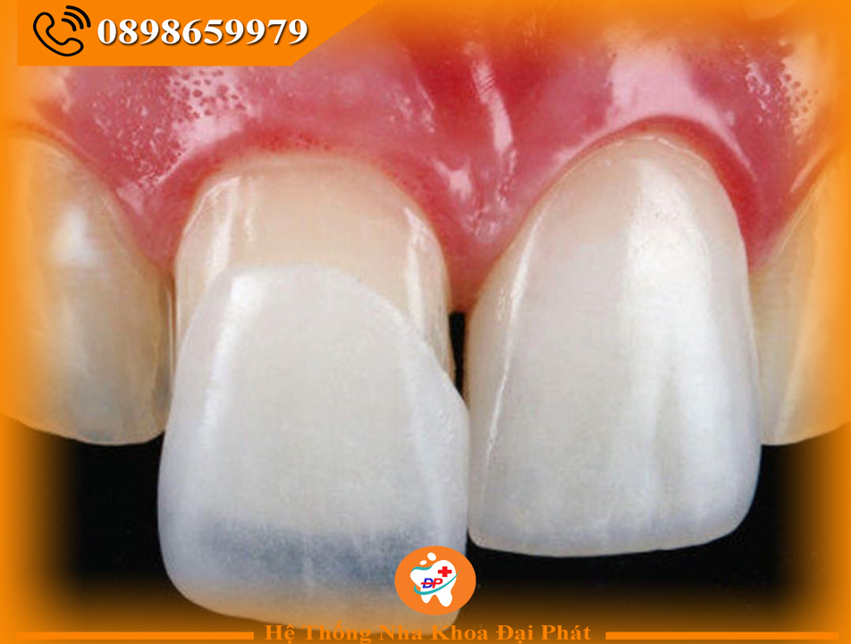 MẶT DÁN SỨ VENEER - ĐỈNH CAO CÔNG NGHỆ