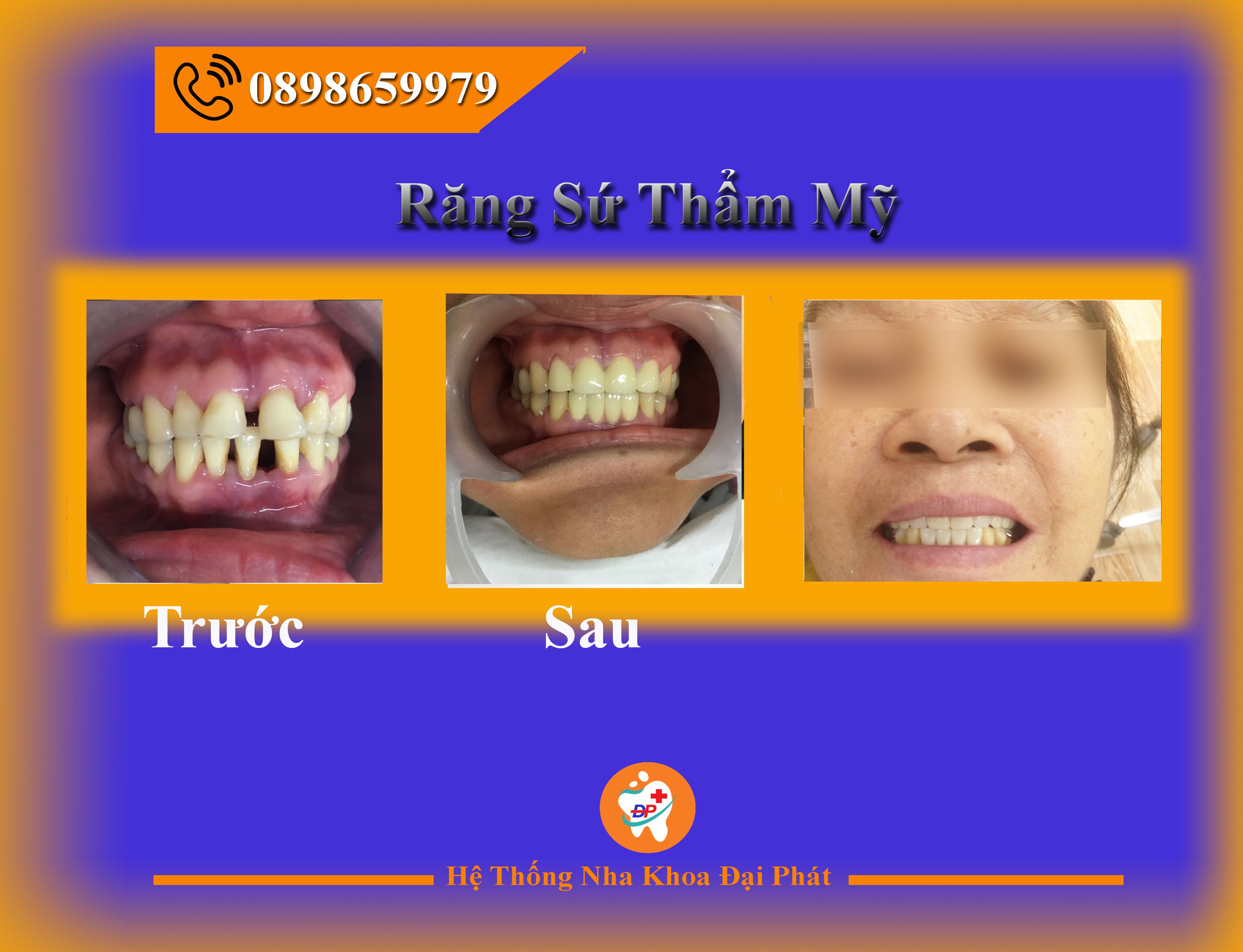 Răng Sứ Và Những Điều Có Thể Bạn Chưa Biết