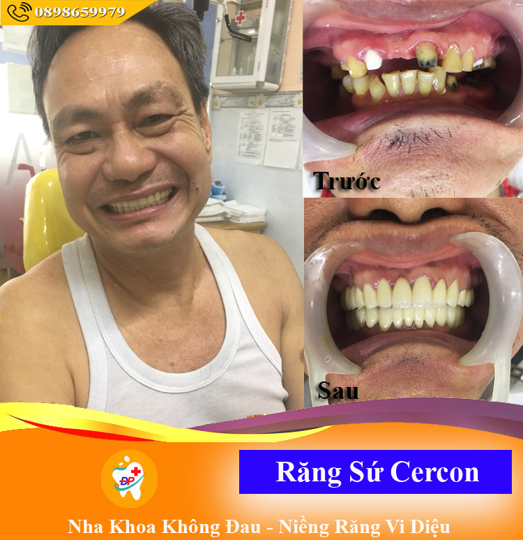 Khách hàng với bộ hàm răng sứ Cercon đã tự tin cười hơn