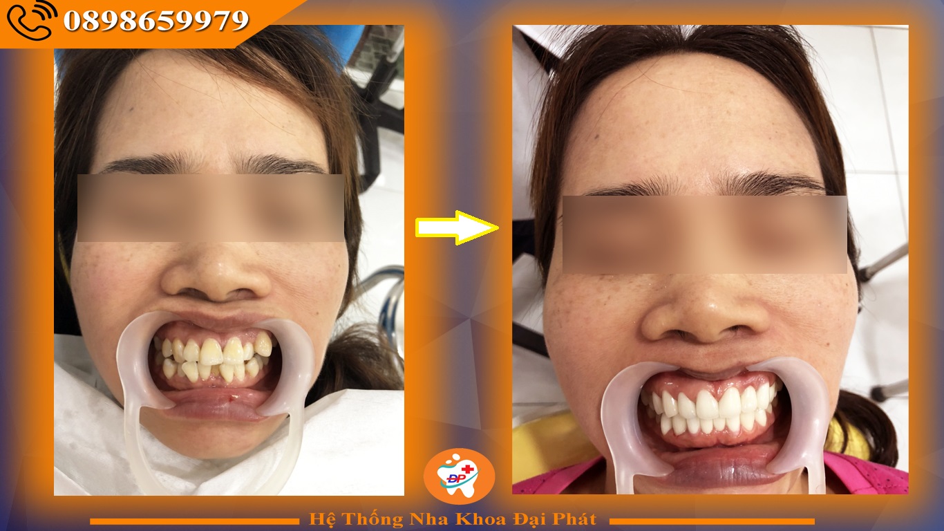 Bọc Răng Sứ ở đâu uy tín tại Biên Hòa ?