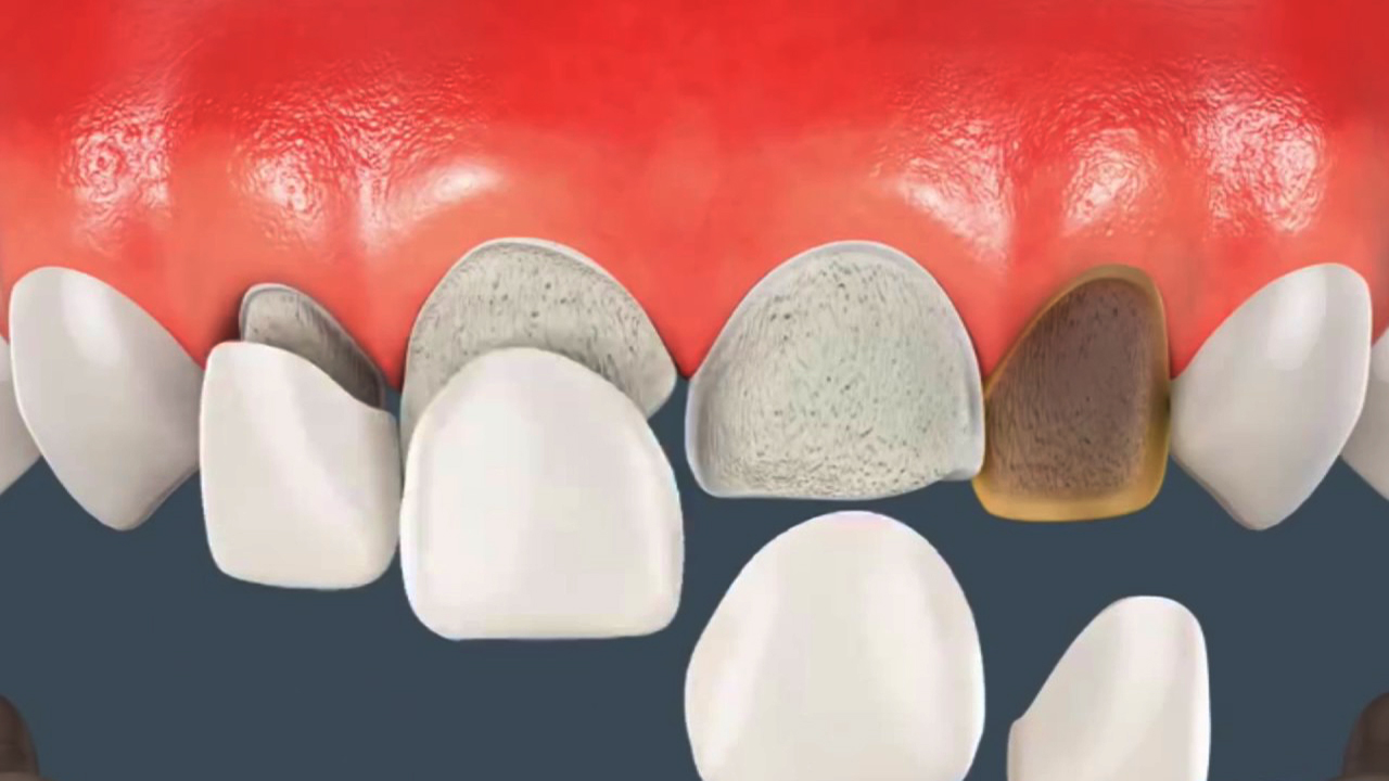 Ưu điểm của Dán Sứ Veneer