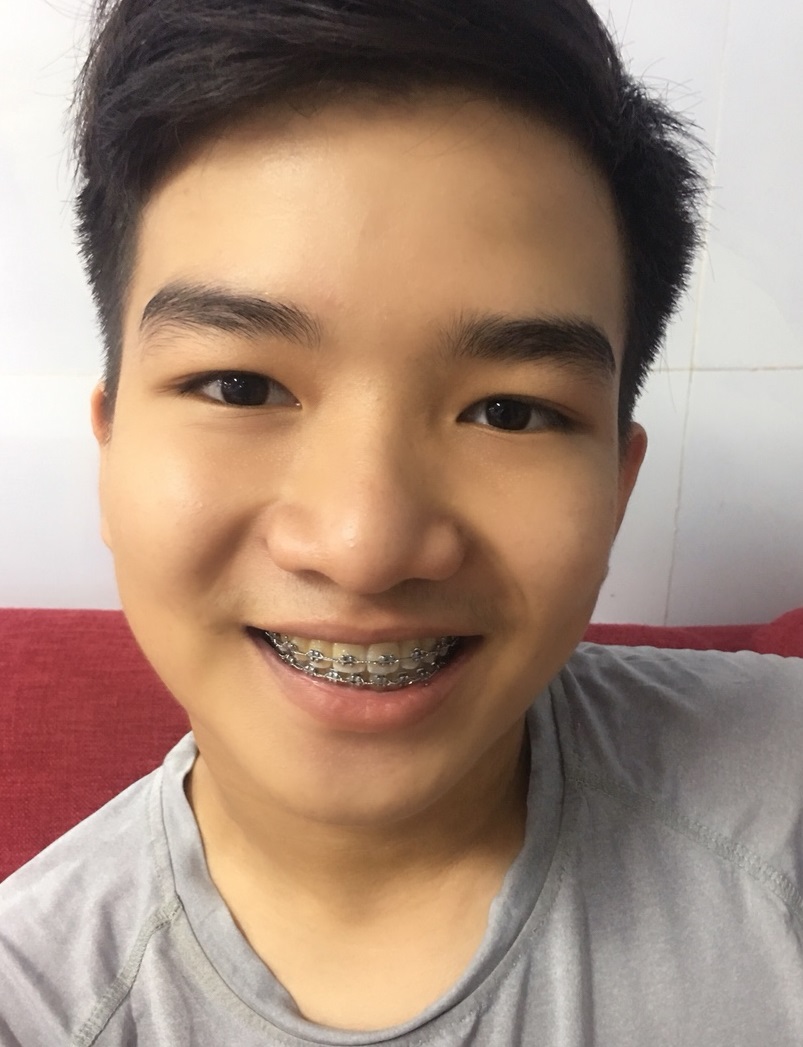 Em Quang Vinh sau 1 năm Niềng Răng tại Đại Phát