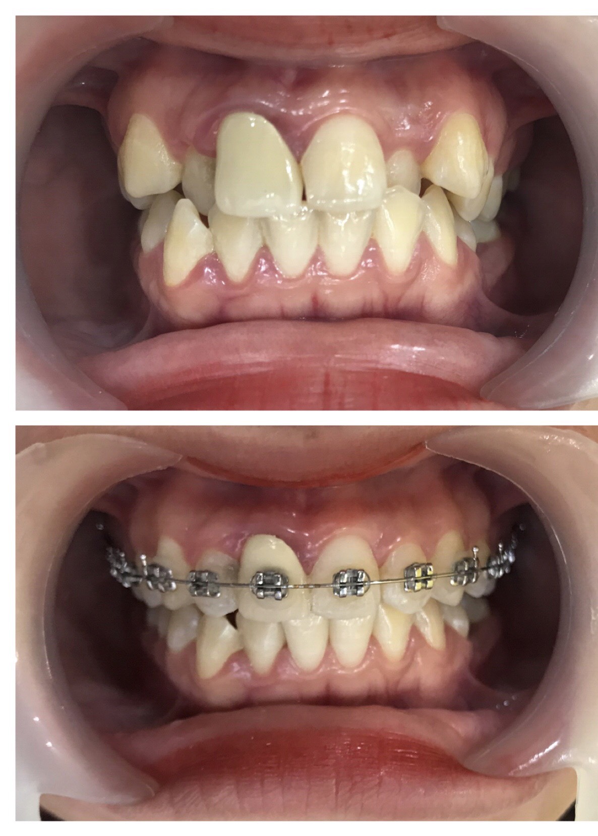 Có thể niềng răng không nhổ răng được không ?
