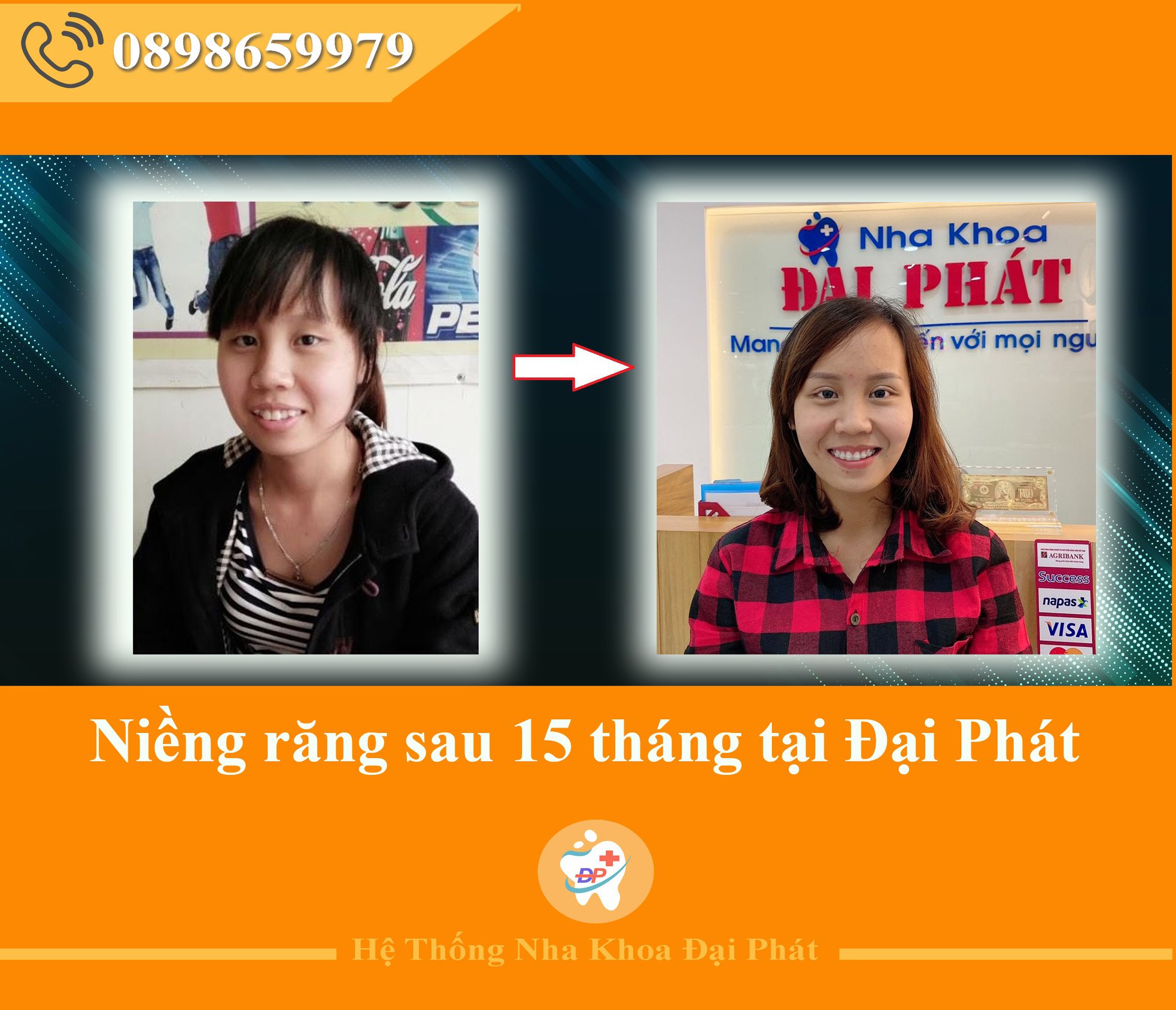 Khách hàng sau 15 tháng niềng răng tại Đại Phát