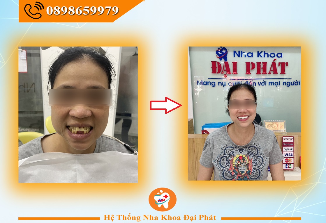 Hình ảnh khách hàng làm răng sứ Zico 2 hàm