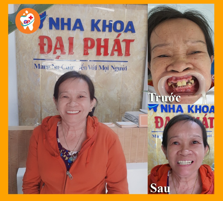 Cô ấy đã hoàn thành răng sứ 2 hàm sau 4 năm tích góp