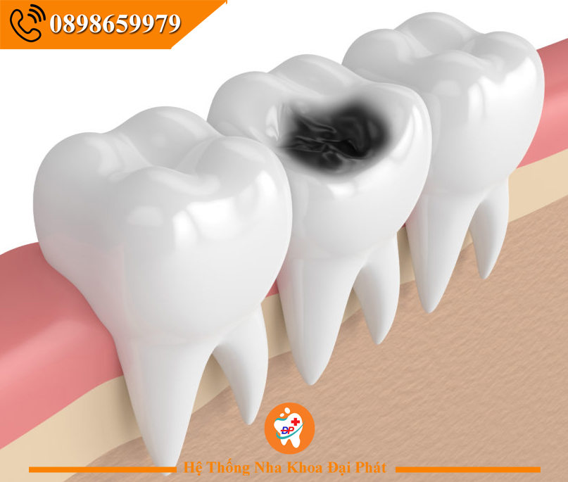 CÁC BỆNH RĂNG MIỆNG THƯỜNG GẶP NHẤT