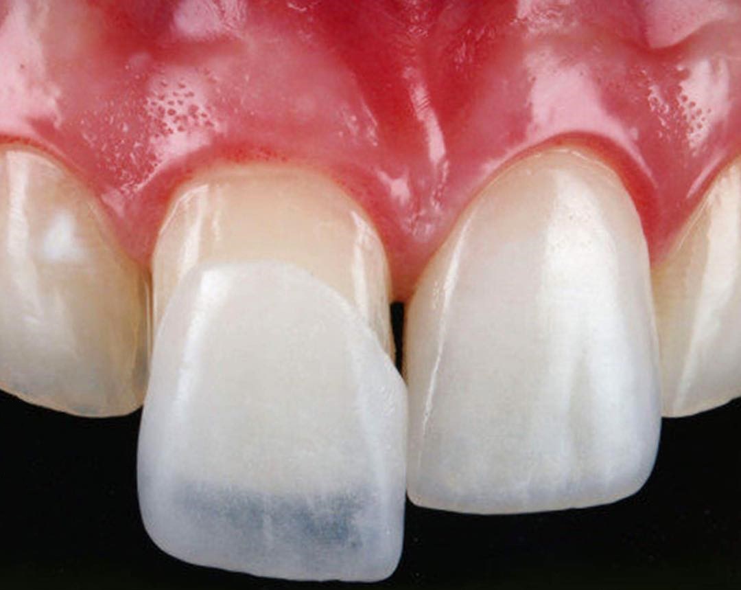 Quy Trình Dán Sứ Veneer - Nha Khoa Biên Hòa