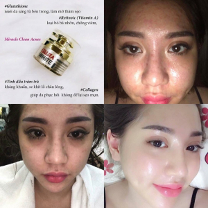 FEEDBACK TRỊ MỤN TỪ 18/1/2018 - 28/1/2108