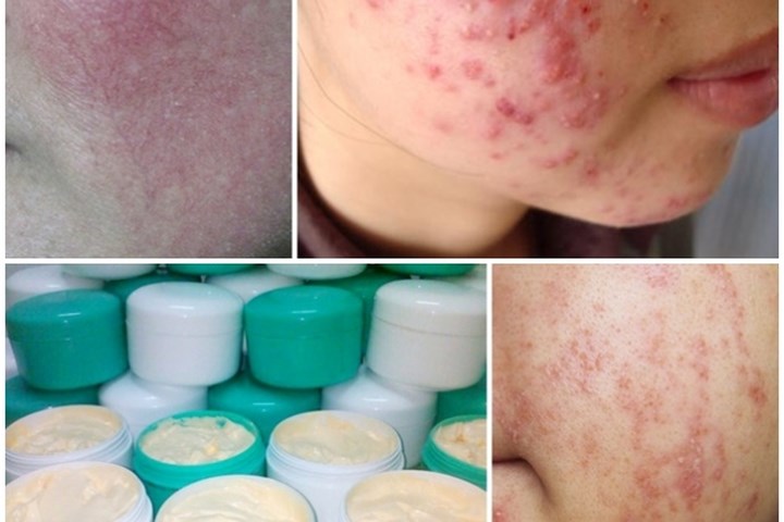 Nguy cơ tiềm ẩn từ tẩy trắng da