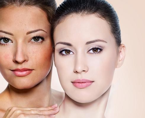 Cảnh báo: Nguy cơ nám da do tia UV
