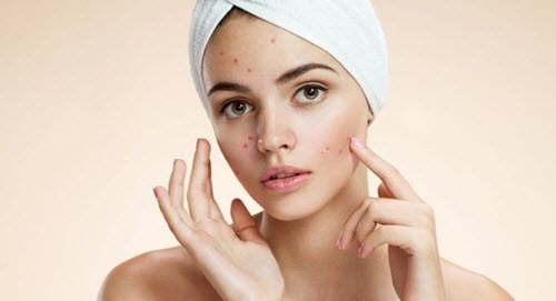 Cảnh báo mụn có thể theo bạn ở mọi lứa tuổi