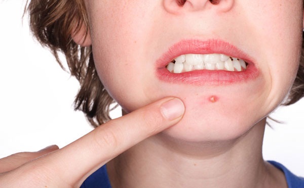 CẢNH BÁO: Tại sao mặt lại lên nhiều mụn mủ như thế?