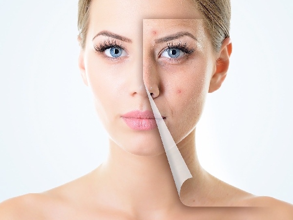 Cảnh báo biến chứng do mụn gây ra mà ít ai biết đến