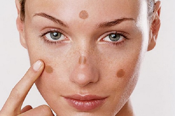 Những lưu ý khi điều trị nám và tàn nhang