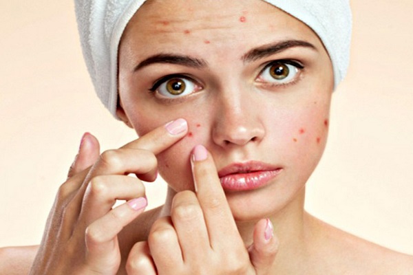 Mụn mọc như “nở qua trên mặt” do những thói quen hàng ngày của bạn 