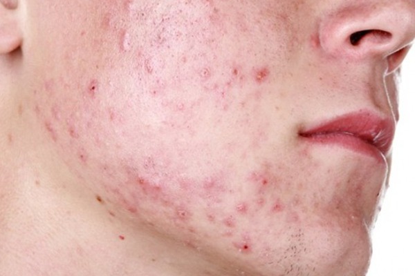 Những nguyên nhân không tưởng dẫn đến mụn trên da của bạn