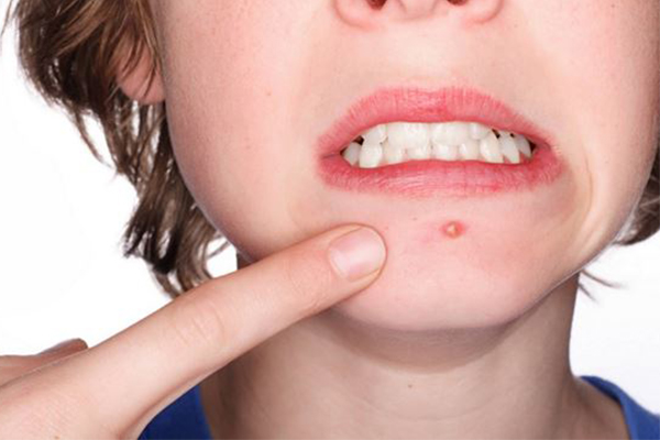 Những Sai Lầm Về Nặn Mụn Mà Ít Ai Biết