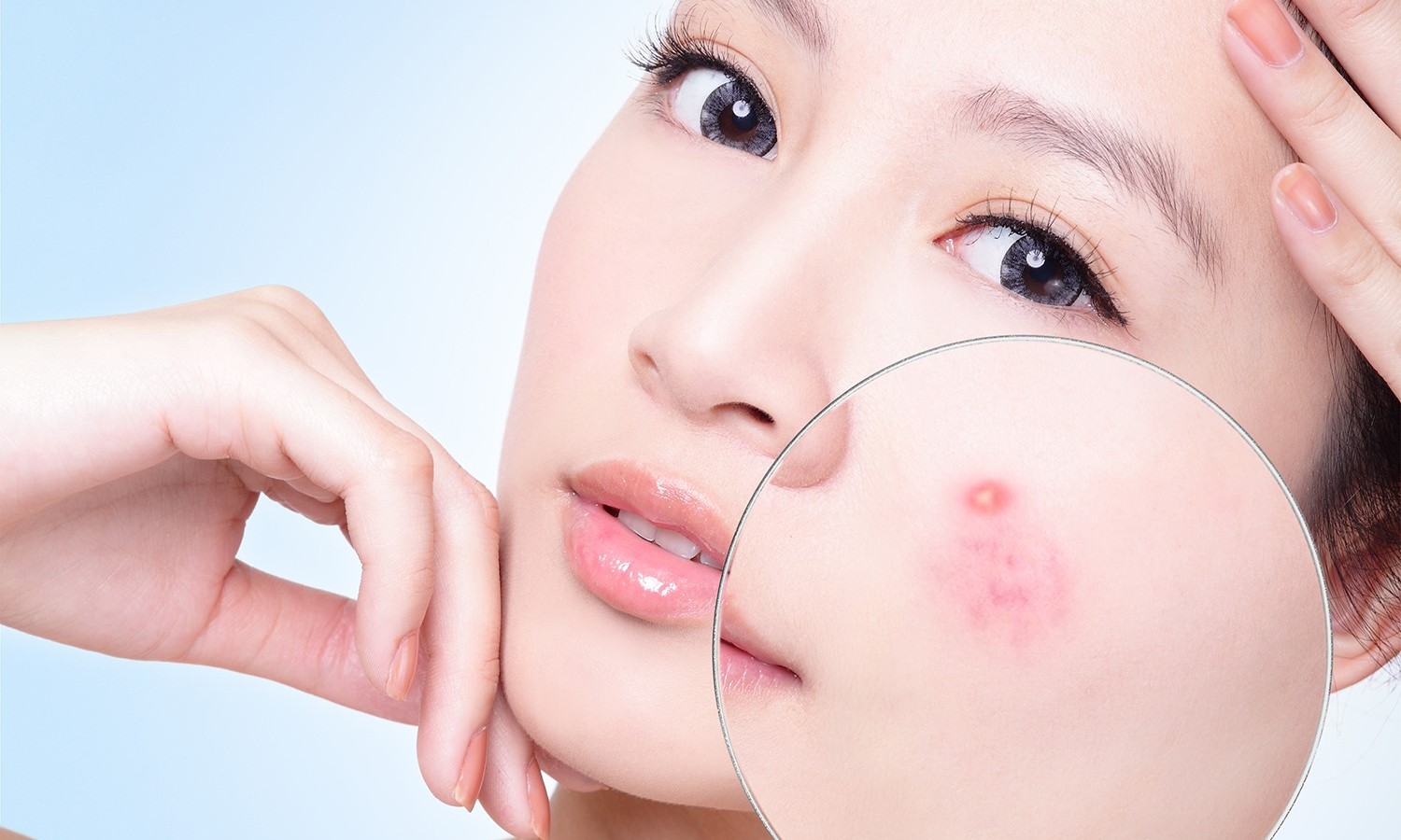 Cảnh báo trị mụn không đúng cách gây mụn tràn lan