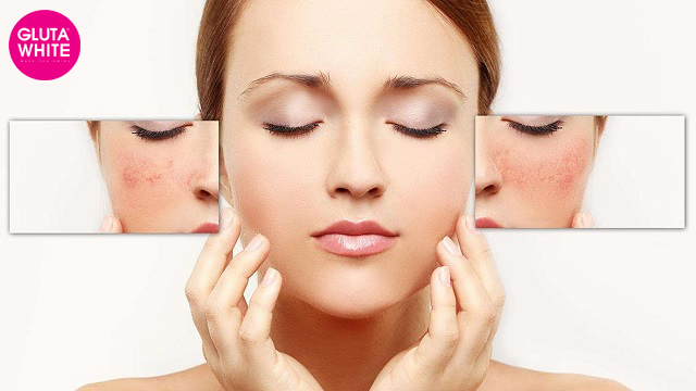 TẠM BIỆT NÁM VỚI MIRACLE CLEAN MELASMA